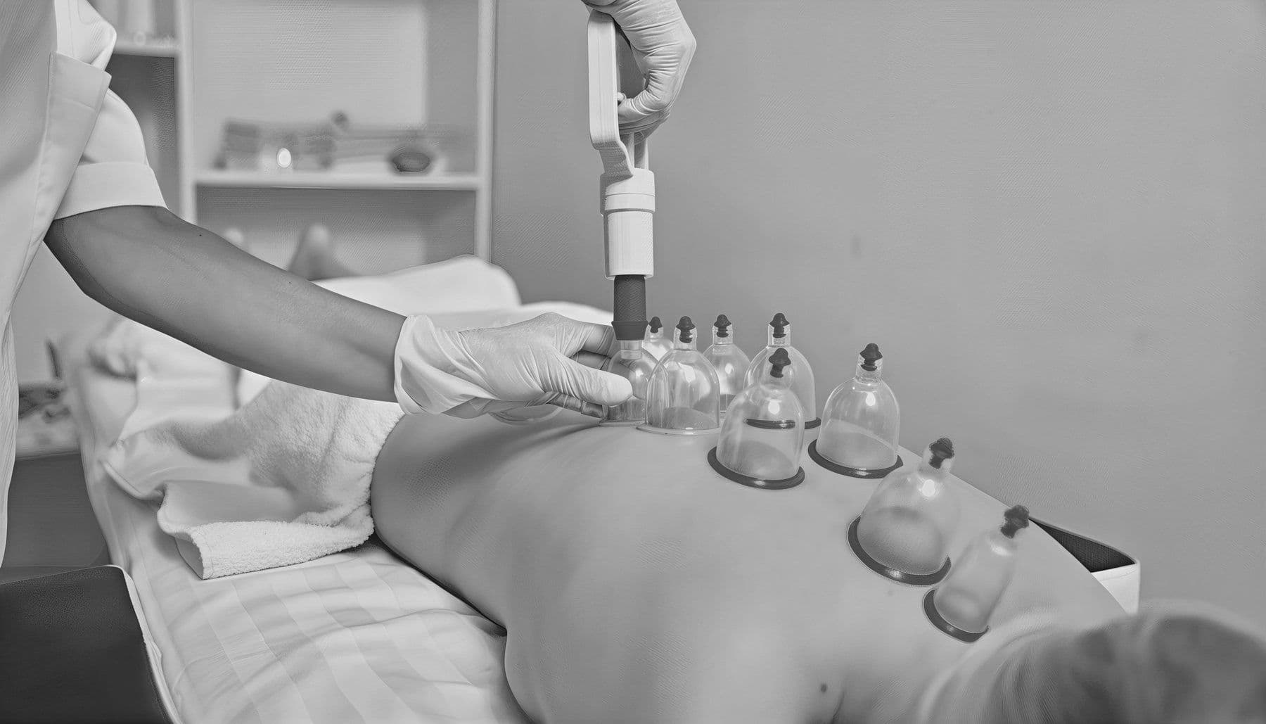 Θεραπεία με βεντούζες (cupping) στην πλάτη στο Physiowave
